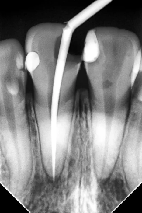i-Sensor : Capteur de Radiologie digitale - WOODPECKER – Image 3